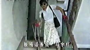 Polio Woman with Crutches and Dangling Leg