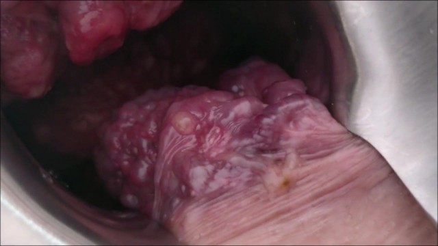 Inside  view of my extreme Prolapse asshole